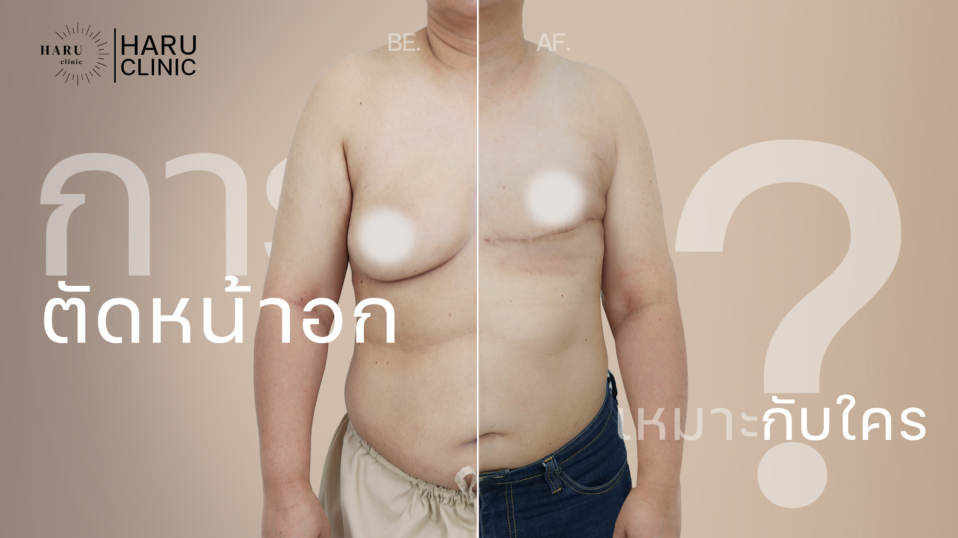 การผ่าตัดหน้าอกทอม/ทรานส์ เหมาะกับใคร?