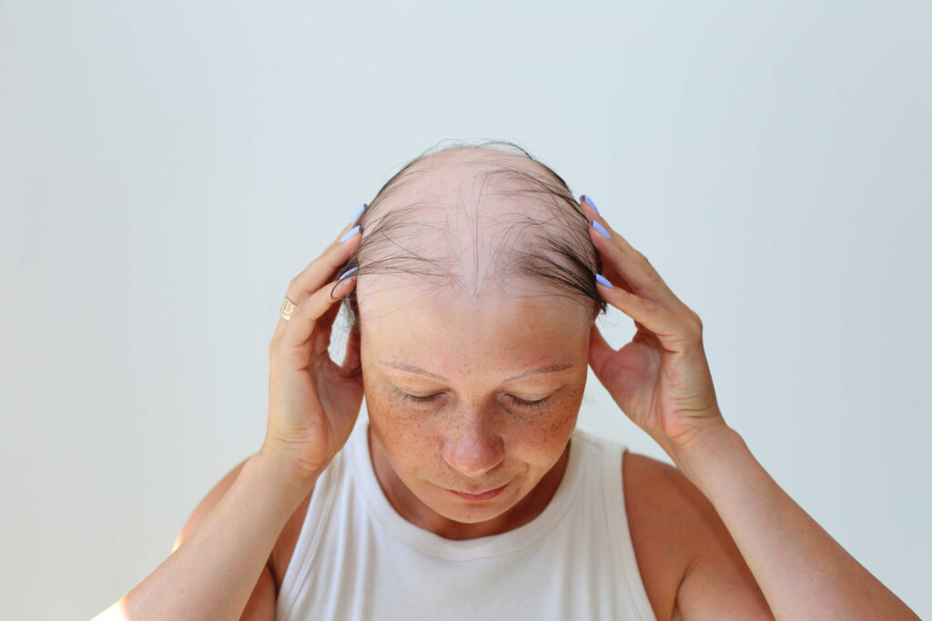 อยู่ดีๆ ผมก็หายเป็นวง? ทำความรู้จัก "โรคผมร่วงเป็นหย่อม" (Alopecia Areata)