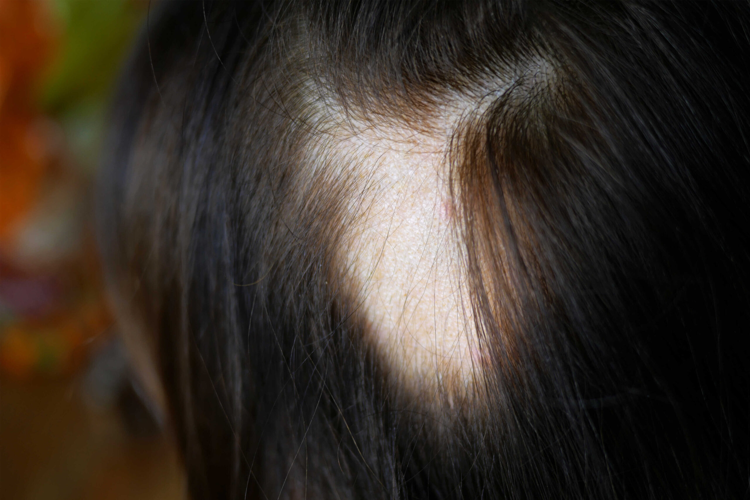 อยู่ดีๆ ผมก็หายเป็นวง? ทำความรู้จัก "โรคผมร่วงเป็นหย่อม" (Alopecia Areata)