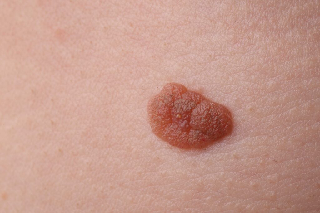 บริการตัดไฝ ติ่งเนื้อ หูด