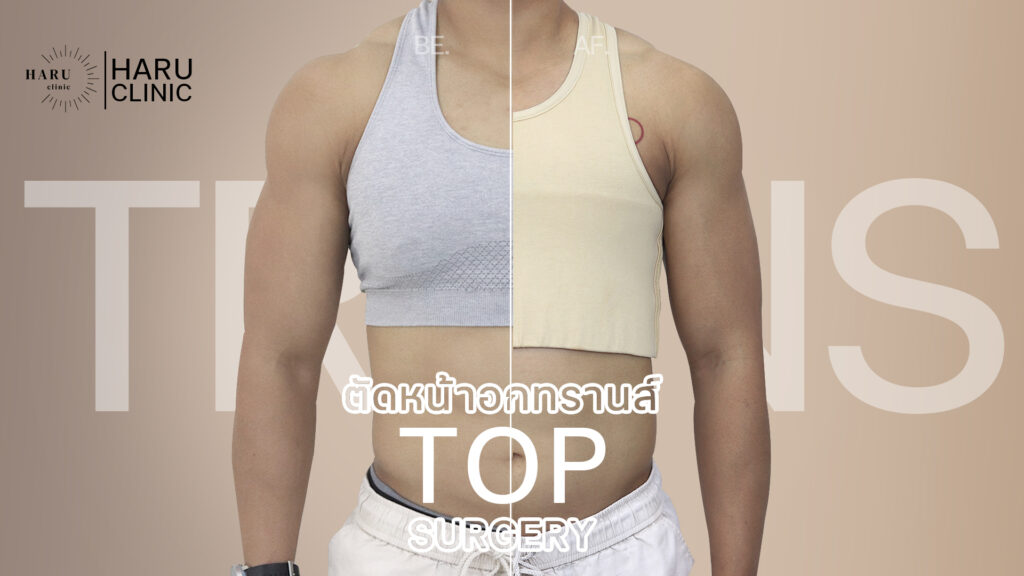 ผ่าตัดตัดหน้าอกทอม (Top Surgery / Mastectomy)