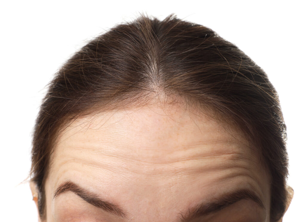 โปรแกรมโบทอกซ์ (Botox)