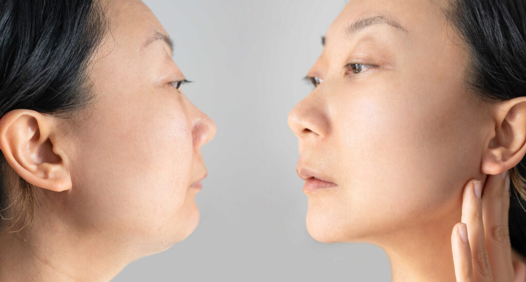 ดูดไขมันเหนียง กรอบหน้า (Facial Liposuction)