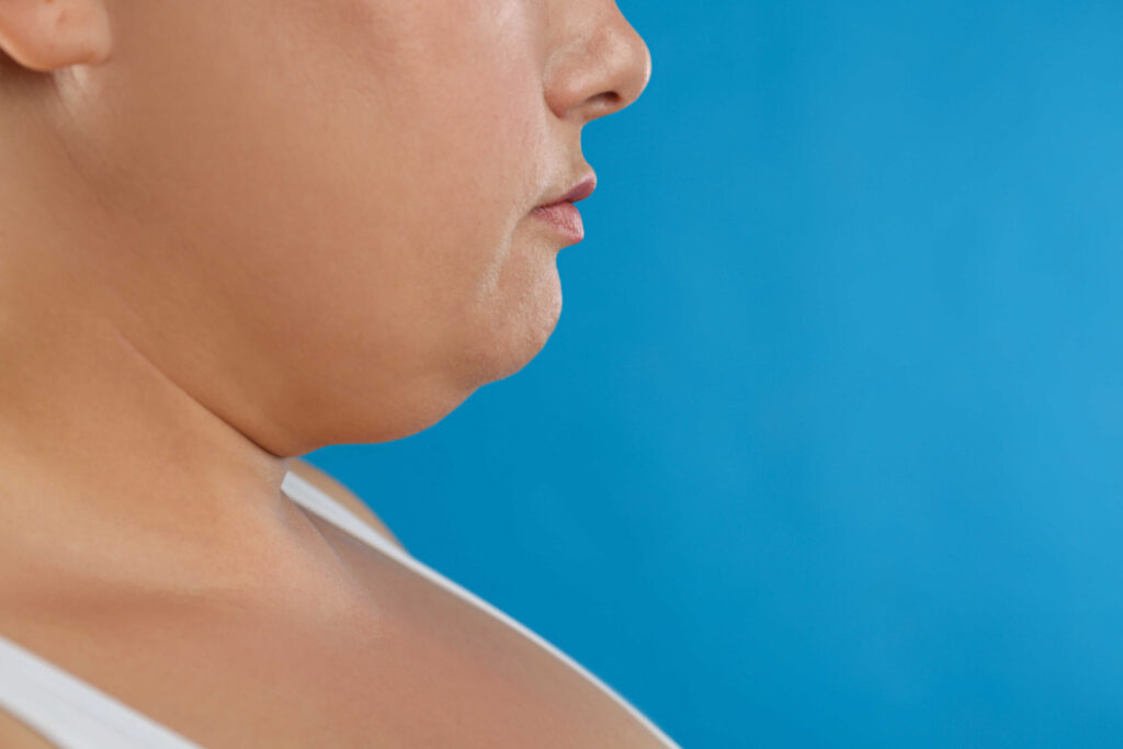 ดูดไขมันเหนียง กรอบหน้า (Facial Liposuction)